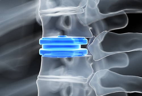 Artifical Disc Replacement Graphic | Interventional Spine & Surgery Group