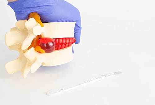 Percutaneous Discectomy 3D Model | Interventional Spine and Surgery Group
