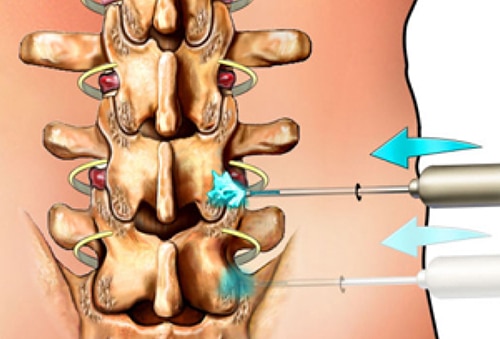 What is a Rhizotomy Graphic | Interventional Spine and Surgery Group