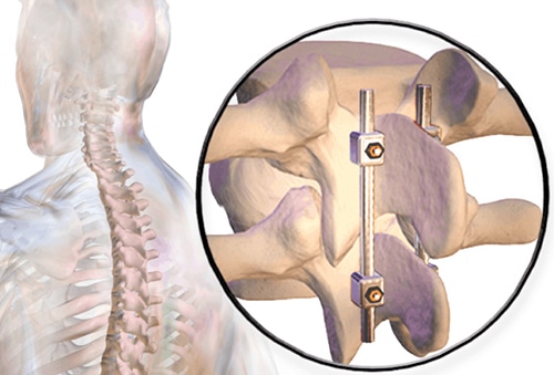 cervical lumbar fusion