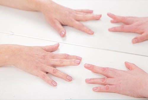 complex regional pain syndrome