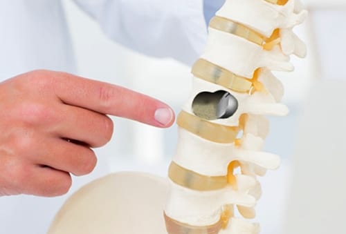 kyphoplasty