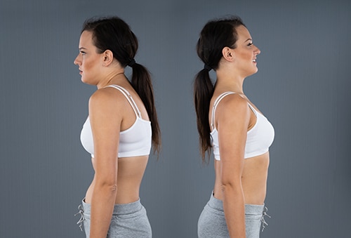 kyphosis