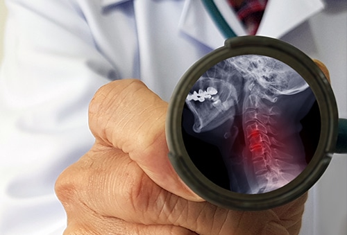 radiculopathy