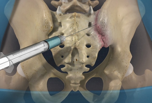 sacroiliac joint injections