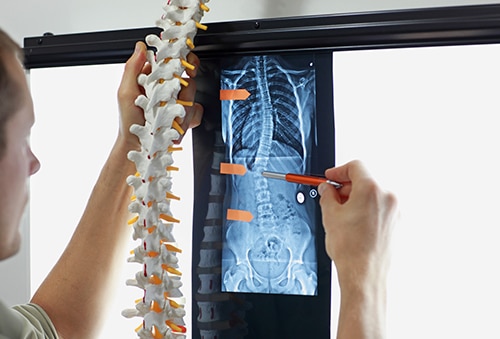 scoliosis