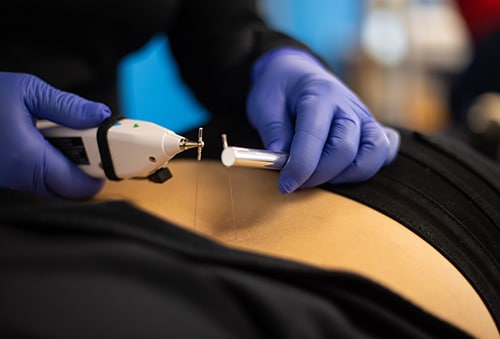 spinal cord stimulator