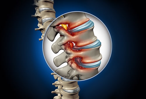 stenosis
