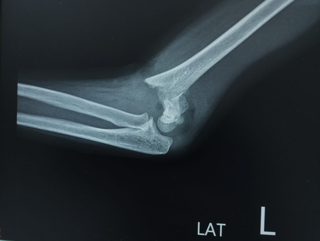 X-ray image of left elbow fracture