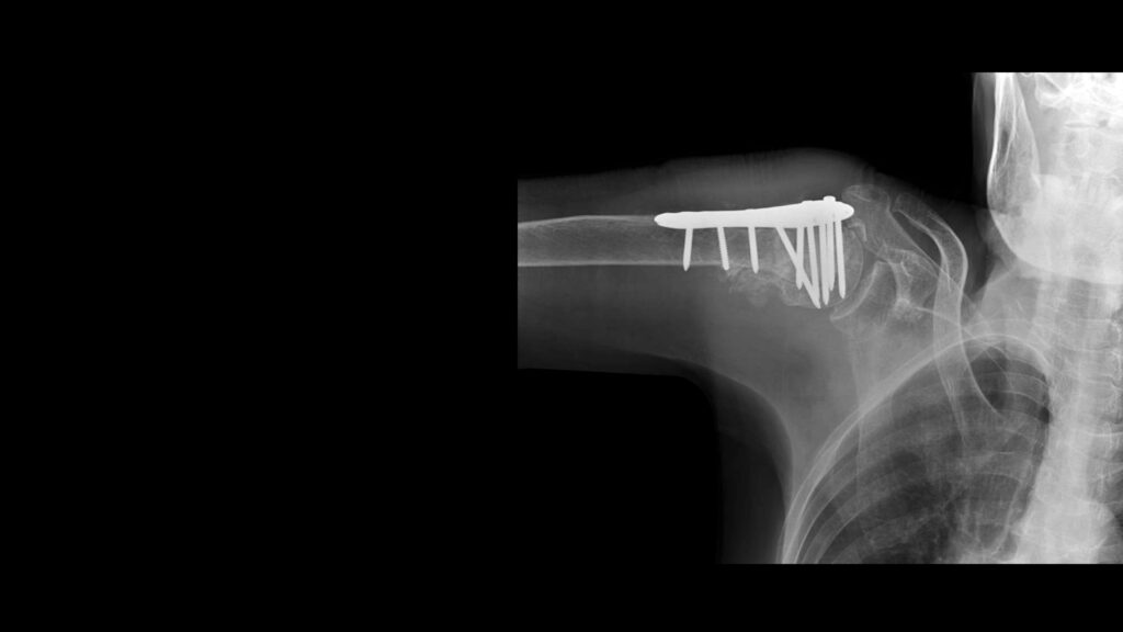 X-ray image of shoulder bone treated with ORIF surgery