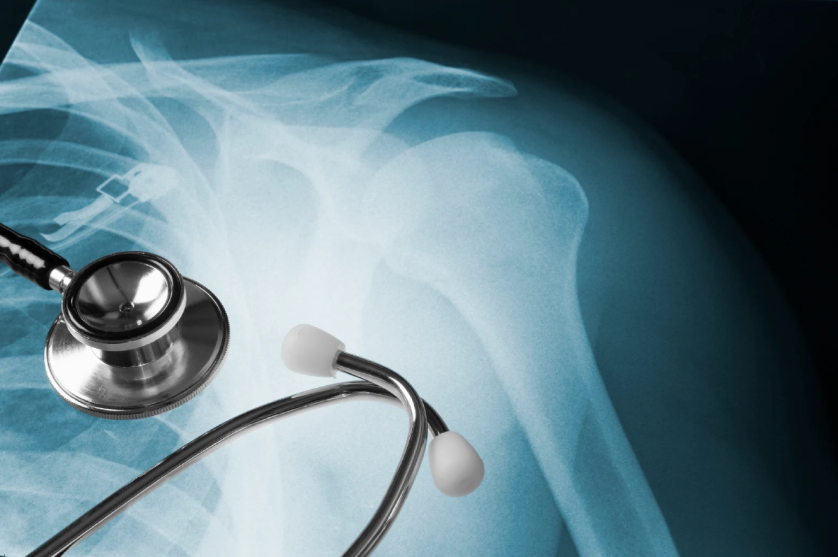 Stethoscope on top of X-ray showing shoulder dislocation