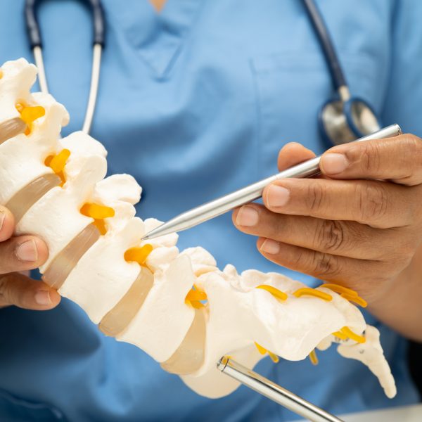 asian doctor holding spinal nerve and bone model, lumbar spine displaced herniated disc fragment for treatment medical in the orthopedic department.